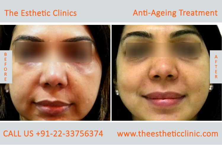 Anti Aging Treatment for Face Wrinkles before after photos in mumbai india (1 (7)